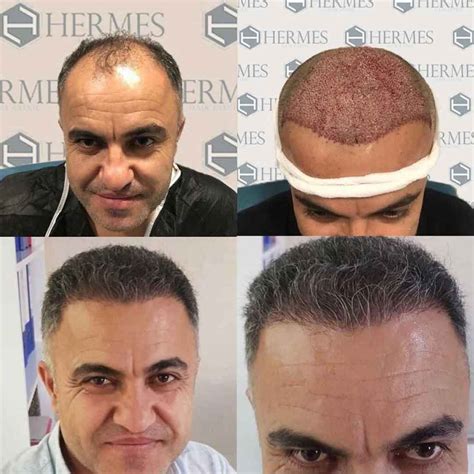 hermest hair transplant yorumları